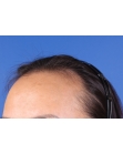 Before Hair Transplant&nbsp;Hairline
